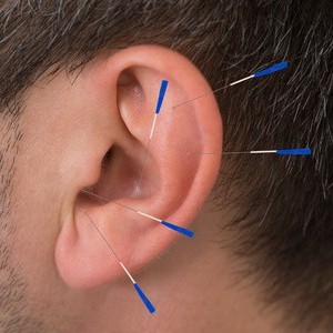 auricular-therapy